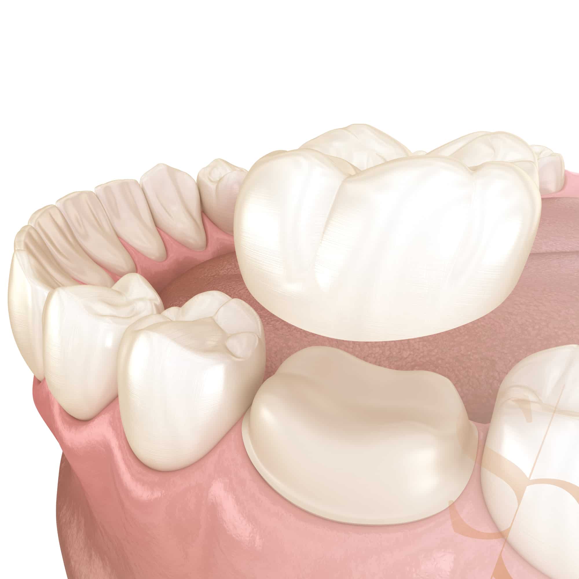 Quelle est la différence entre une facette dentaire et une couronne dentaire  ?, Clinique Sana Oris