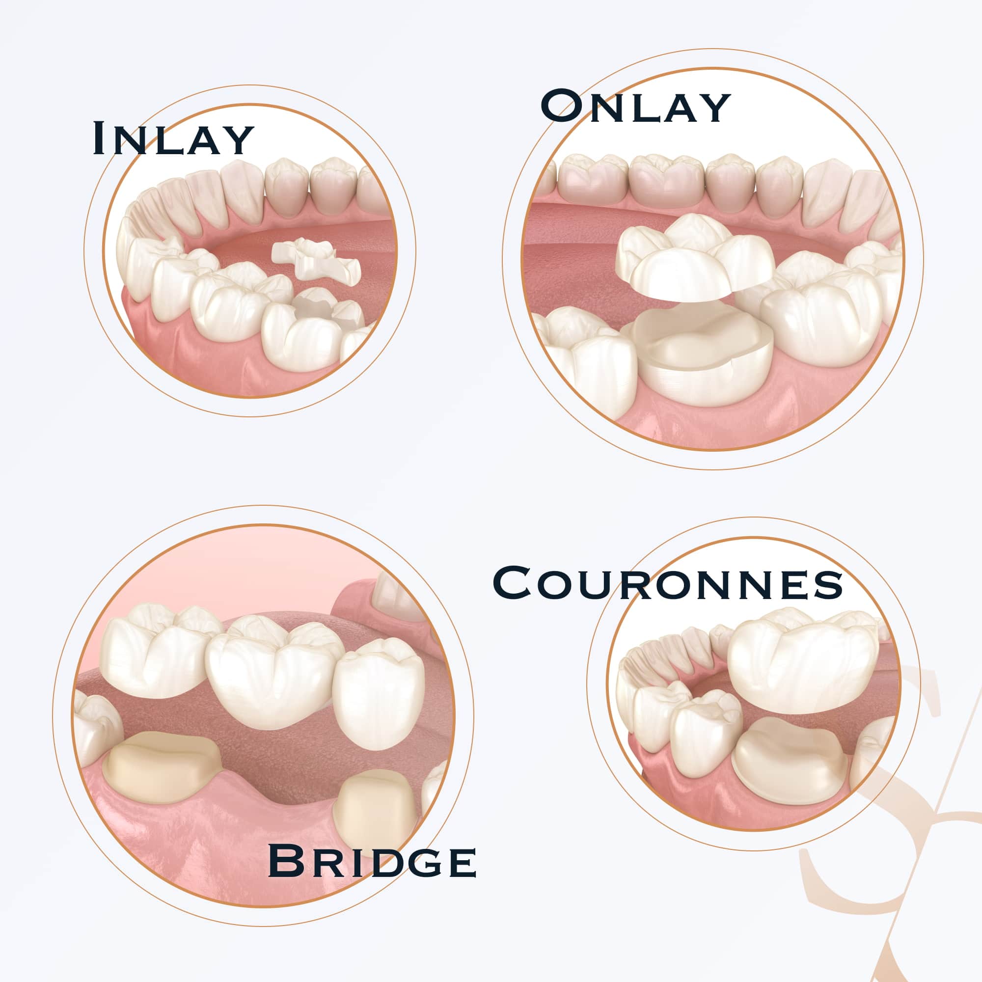 Prothèses dentaires: fixes/amovibles, partielles/complètes, sur implants
