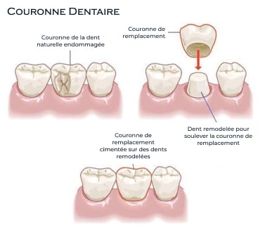 Prothésiste dentaire : Quel est sont rôle ? - Guide dentaire - Dentego