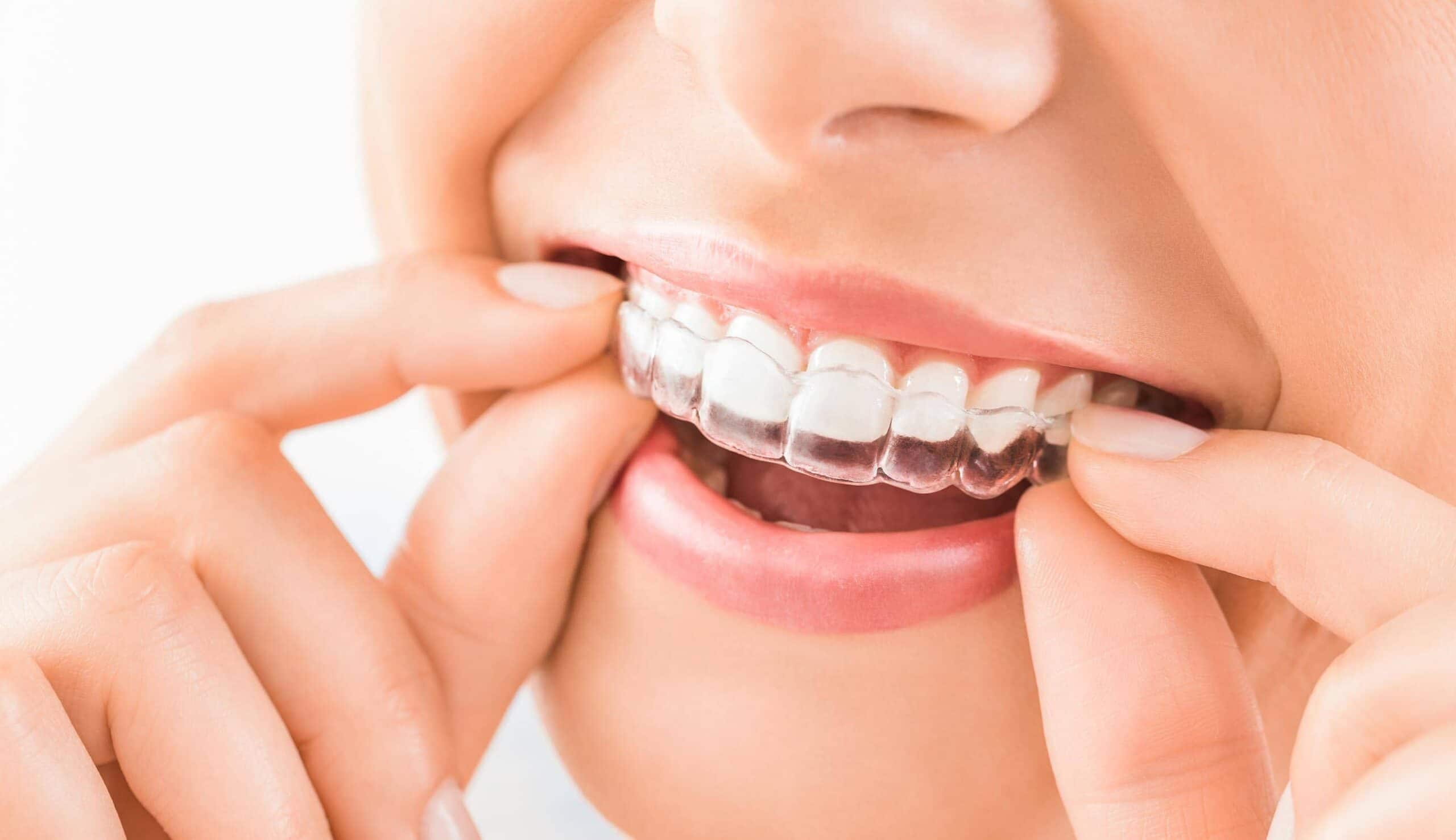 Blanchiment des dents avec gouttière (dents jaunes) à Paris, Technique et  prix