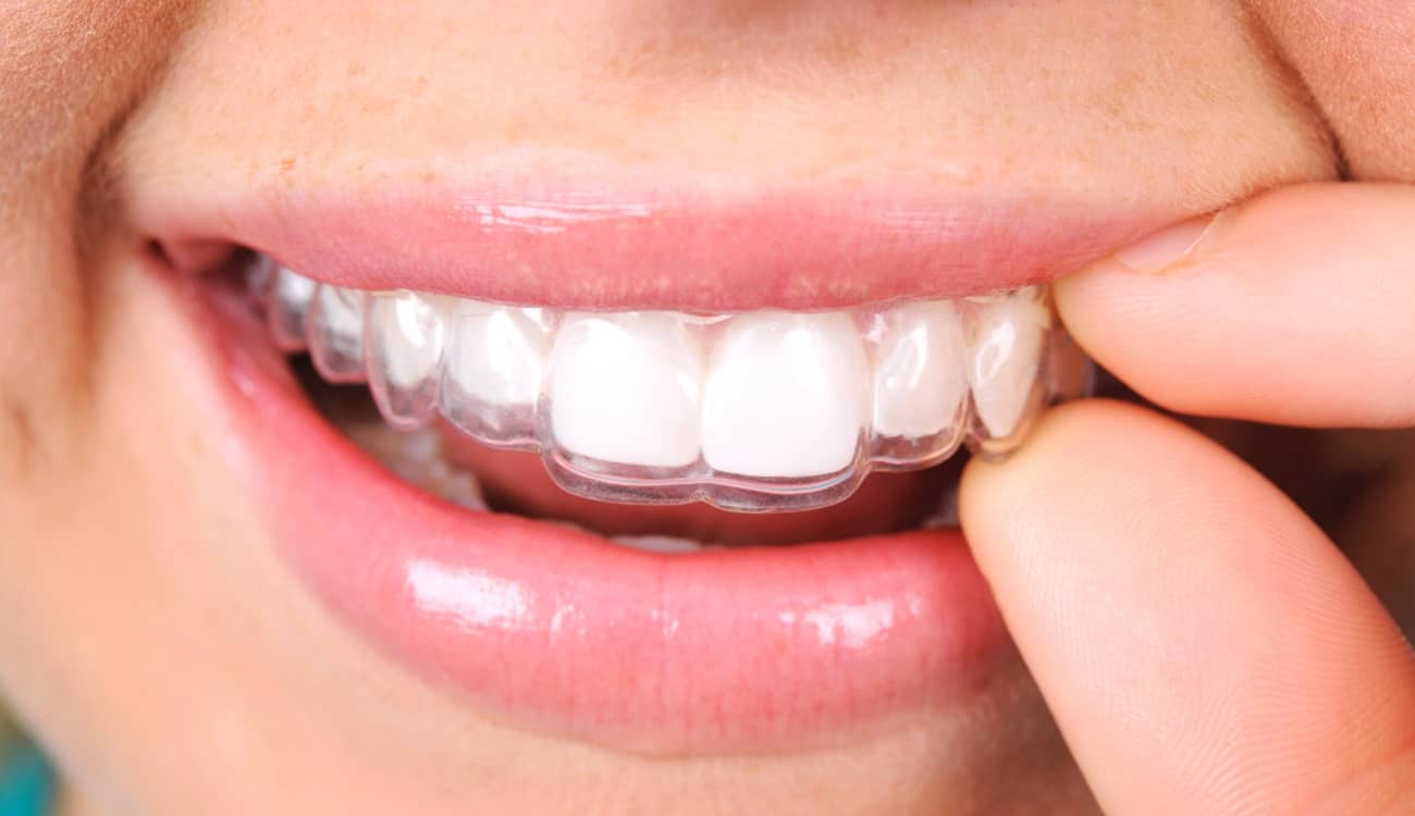 Quels appareils pour aligner ses dents ?, Clinique Sana Oris