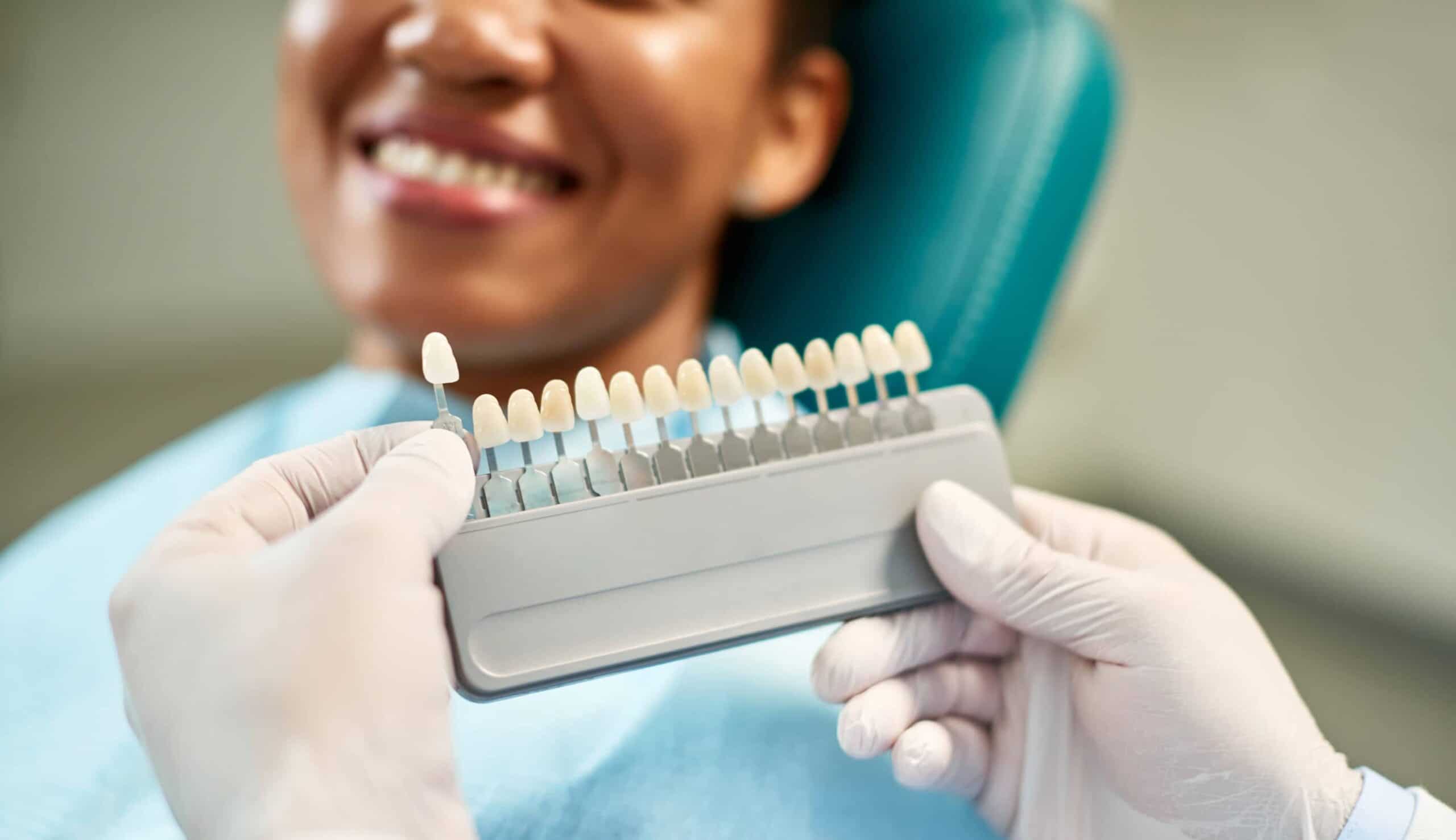 Quelle est la différence entre une facette dentaire et une couronne dentaire  ?, Clinique Sana Oris