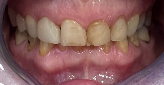 Facettes dentaire : Avant - Après, résultats après la pose