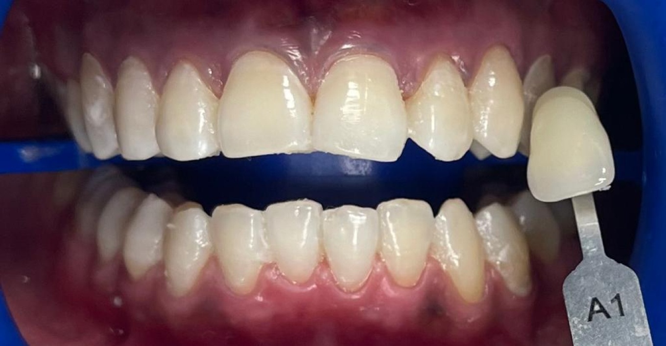 Blanchiment des dents avec gouttière (dents jaunes) à Paris, Technique et  prix